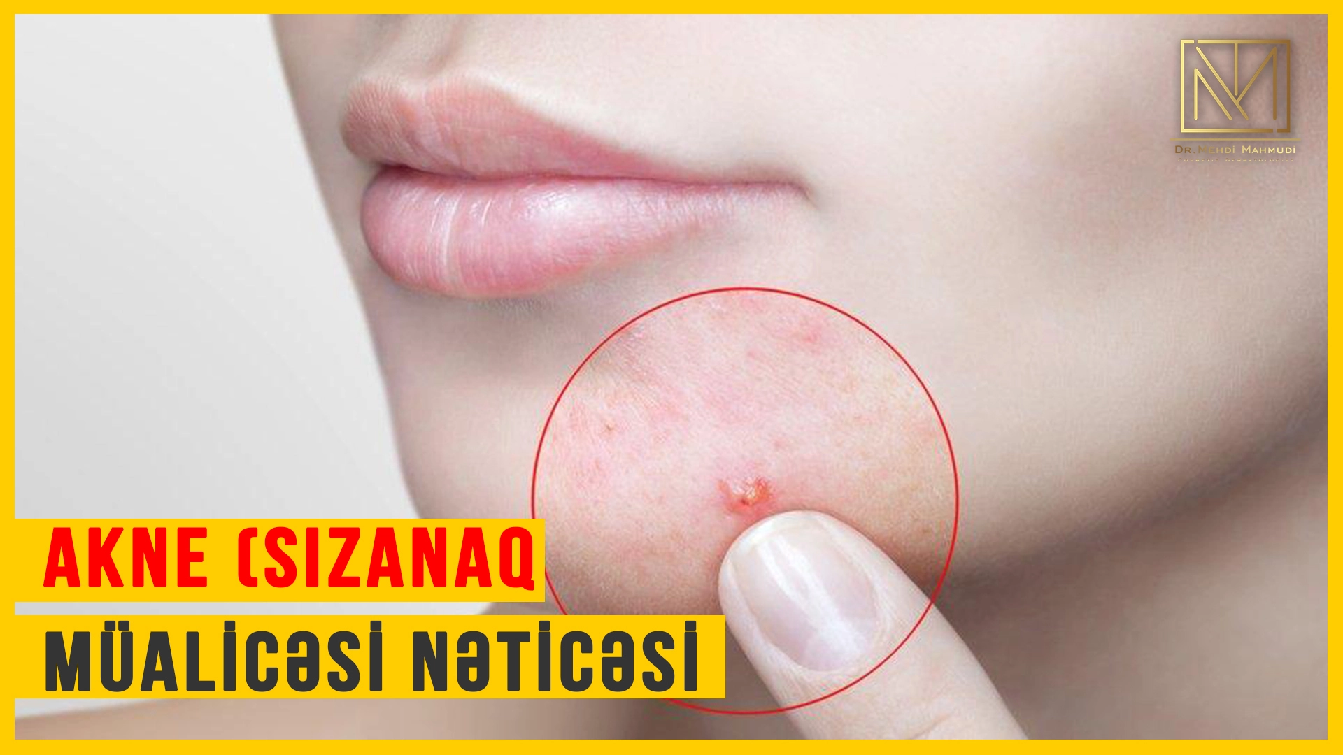 Akne (Sızanaq) Müalicəsinin Nəticəsi | Dr. Mehdi Mahmudi #dermatoloq​ #sızanaq